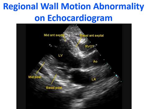 abnormal wall motion on echocardiogram.